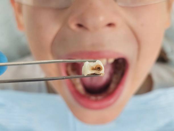 Best Emergency Dental Filling Replacement  in Stanaford, WV